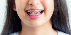 Выравнивание детских зубов брекетами